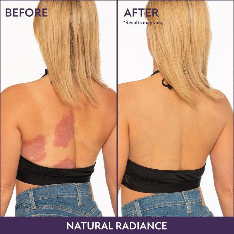 💝Natural body concealer (waterproof, cover body tattoo, scar & birthmark)